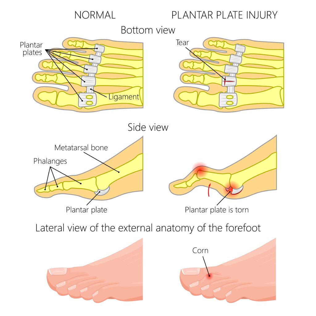 Plantar Plate Injury MSK Patient Portal NHS Ayrshire Arran