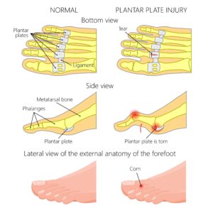 Plantar plate injury (MSK Patient Portal) - NHS Ayrshire & Arran