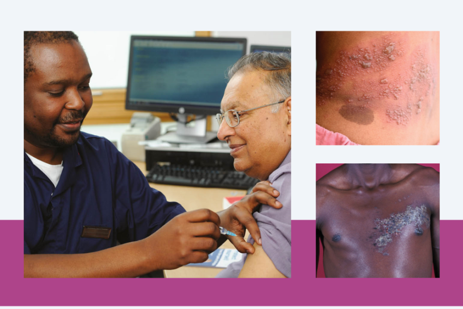 Healthcare worker giving patient a shingles vaccine; images of shingles rash