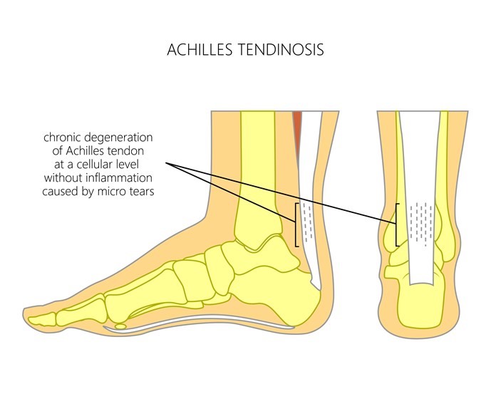 An anatomical illustration showing two views of a foot affected by "Achilles Tendinosis":

The left side of the image shows the side view of a foot with the Achilles tendon highlighted and a section of it enlarged to show the area of chronic degeneration at a cellular level without inflammation, caused by microtears.
The right side shows the back view of a lower leg and heel, indicating the typical location of pain in Achilles tendinosis.