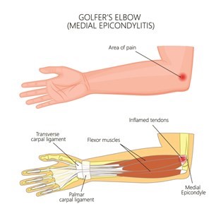 
An illustration depicting "Golfer's Elbow (Medial Epicondylitis)":

It shows the left arm with a highlighted area of pain on the inner elbow.
Detailed view of the elbow joint, showing:
"Inflamed tendons" attached to the "Medial Epicondyle" of the humerus.
"Flexor muscles" of the forearm.
"Transverse carpal ligament" and "Palmar carpal ligament" near the wrist.