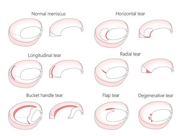 A set of diagrams illustrating various conditions of the meniscus:

"Normal meniscus": A crescent-shaped, intact meniscus.
"Horizontal tear": A horizontal line indicating a tear across the meniscus.
"Longitudinal tear": A vertical tear running along the length of the meniscus.
"Radial tear": A tear that starts from the inner edge and extends outward.
"Bucket handle tear": The inner portion of the meniscus looks like a displaced loop, resembling a bucket handle.
"Flap tear": A section of the meniscus is lifted, creating a flap-like appearance.
"Degenerative tear": Multiple small tears and irregularities present throughout the meniscus.