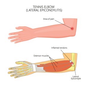 An illustration depicting "Tennis Elbow (Lateral Epicondylitis)":

It shows the right arm with a highlighted area of pain on the outer elbow.
A close-up view of the elbow joint illustrates:
"Inflamed tendons" attached to the "Lateral Epicondyle" of the humerus.
"Extensor muscles" of the forearm.