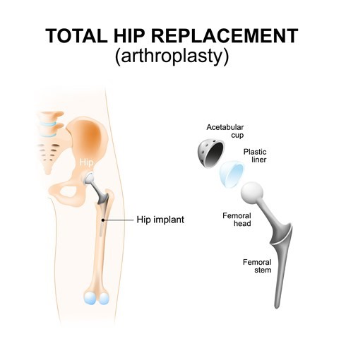 An illustration titled "Total Hip Replacement (arthroplasty)":

On the left, a side view of the pelvis and upper femur with a hip implant in place.
The implant consists of a long stem fitting inside the femur, with a femoral head that sits within the hip socket.
On the right, the separate components of the hip replacement are displayed:
"Acetabular cup": the part that replaces the hip socket.
"Plastic liner": fits inside the acetabular cup to provide a smooth surface.
"Femoral head": the ball component that articulates with the liner.
"Femoral stem": the part that is anchored into the femur.