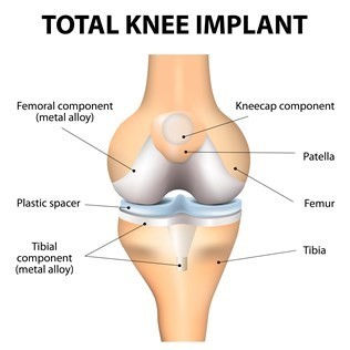 An illustration showcasing a total knee implant:

"Femur": The upper thigh bone.
"Tibia": The shinbone, directly below the knee.
"Patella": The kneecap at the front.
"Femoral component (metal alloy)": A metallic part replacing the end of the femur.
"Tibial component (metal alloy)": A metallic base affixed to the top of the tibia.
"Plastic spacer": A smooth cushion situated between the femoral and tibial components.
"Kneecap component": A prosthetic cover for the natural patella.
The components are highlighted to show how they integrate with the natural anatomy during a knee replacement.